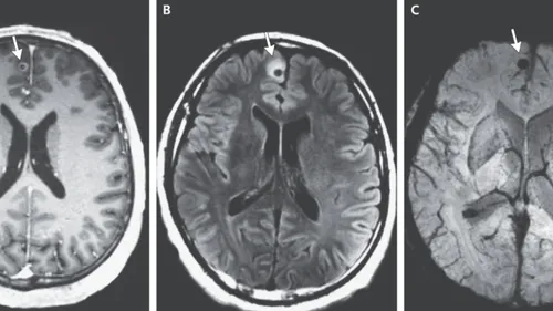 Un ver mort découvert dans le cerveau d’un homme (Photo)